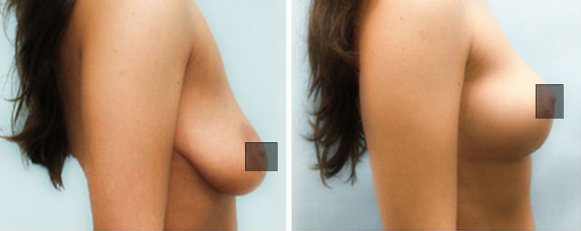Підтяжка грудей - мастопексія: методи. Безопераційна підтяжка, скільки коштує, фото до і після