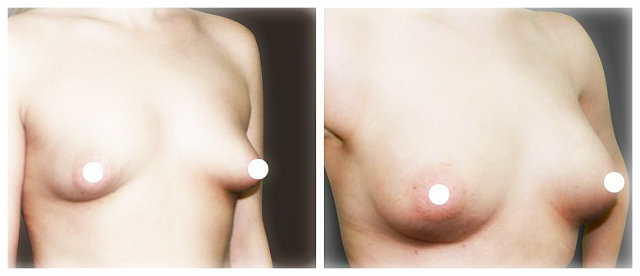 Ліпофілінг грудей: методика, фото до і після, ціни, відгуки, переваги