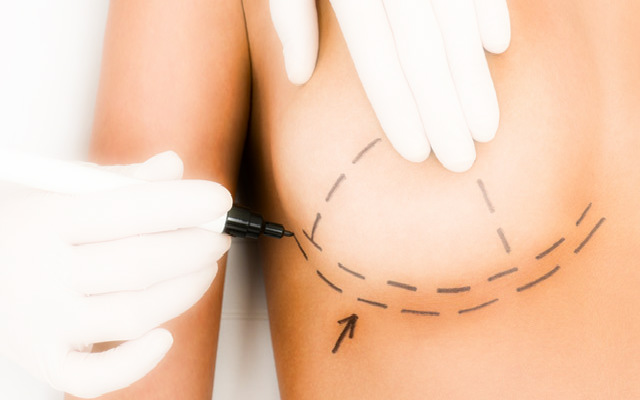 Якірна мастопексія - підтяжка грудей т-подібним способом: методика виконання операції, ціна, відгуки, відео